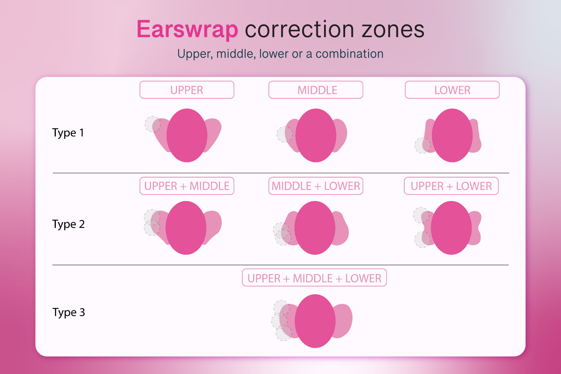 Earswrap correction zones chart: Type 1 upper, middle or lower, Type 2 combinations, Type 3 all three zones